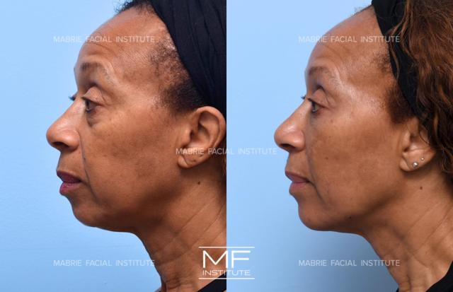 Deep Plane Facelift result at Mabrie Facial Institute in San Francisco, CA