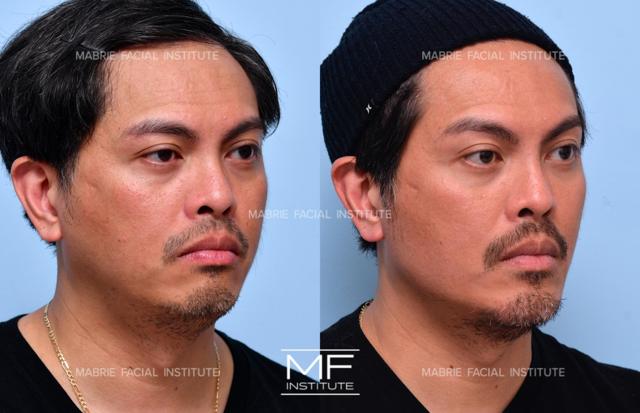 Brow Lift result at Mabrie Facial Institute in San Francisco, CA