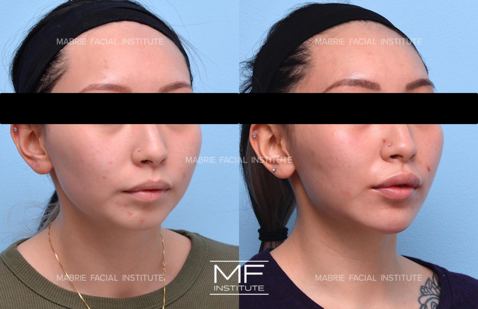 Mabrie Facial Institute chin implant result — San Francisco, CA