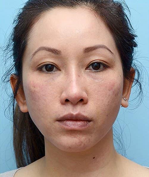 Mabrie Facial Institute after — San Francisco, CA