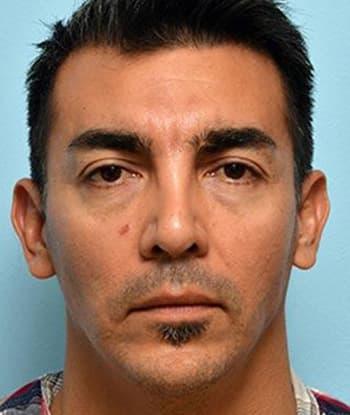 Blepharoplasty before at Mabrie Facial Institute in San Francisco, CA
