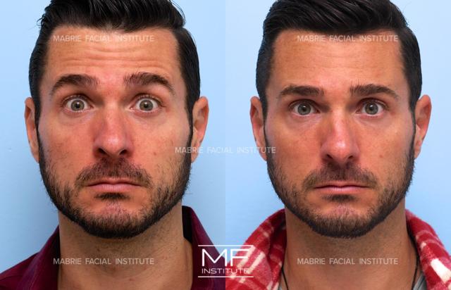 Botox result at Mabrie Facial Institute in San Francisco, CA