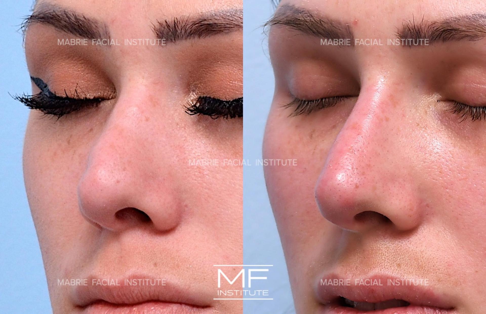 Mabrie Facial Institute rhinoplasty result — San Francisco, CA