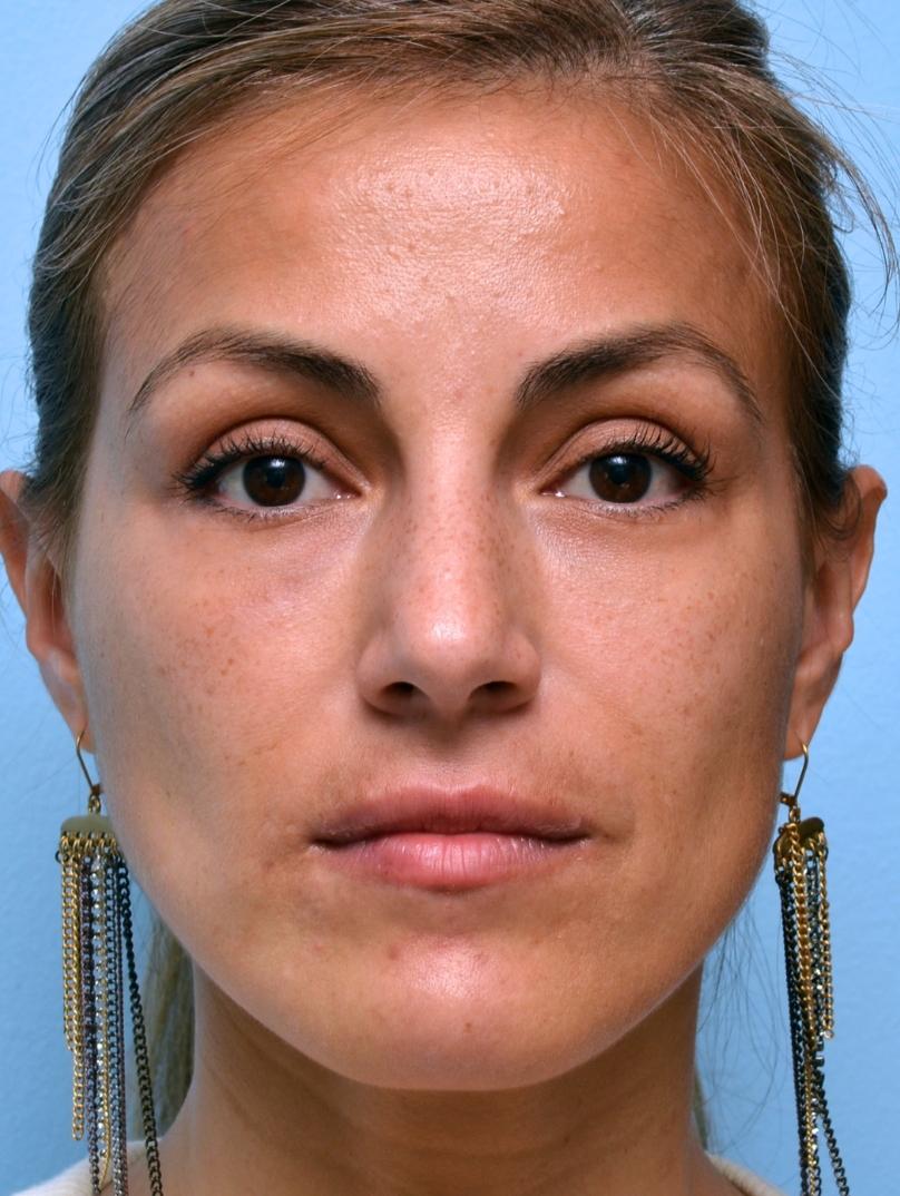 Mabrie Facial Institute after — San Francisco, CA