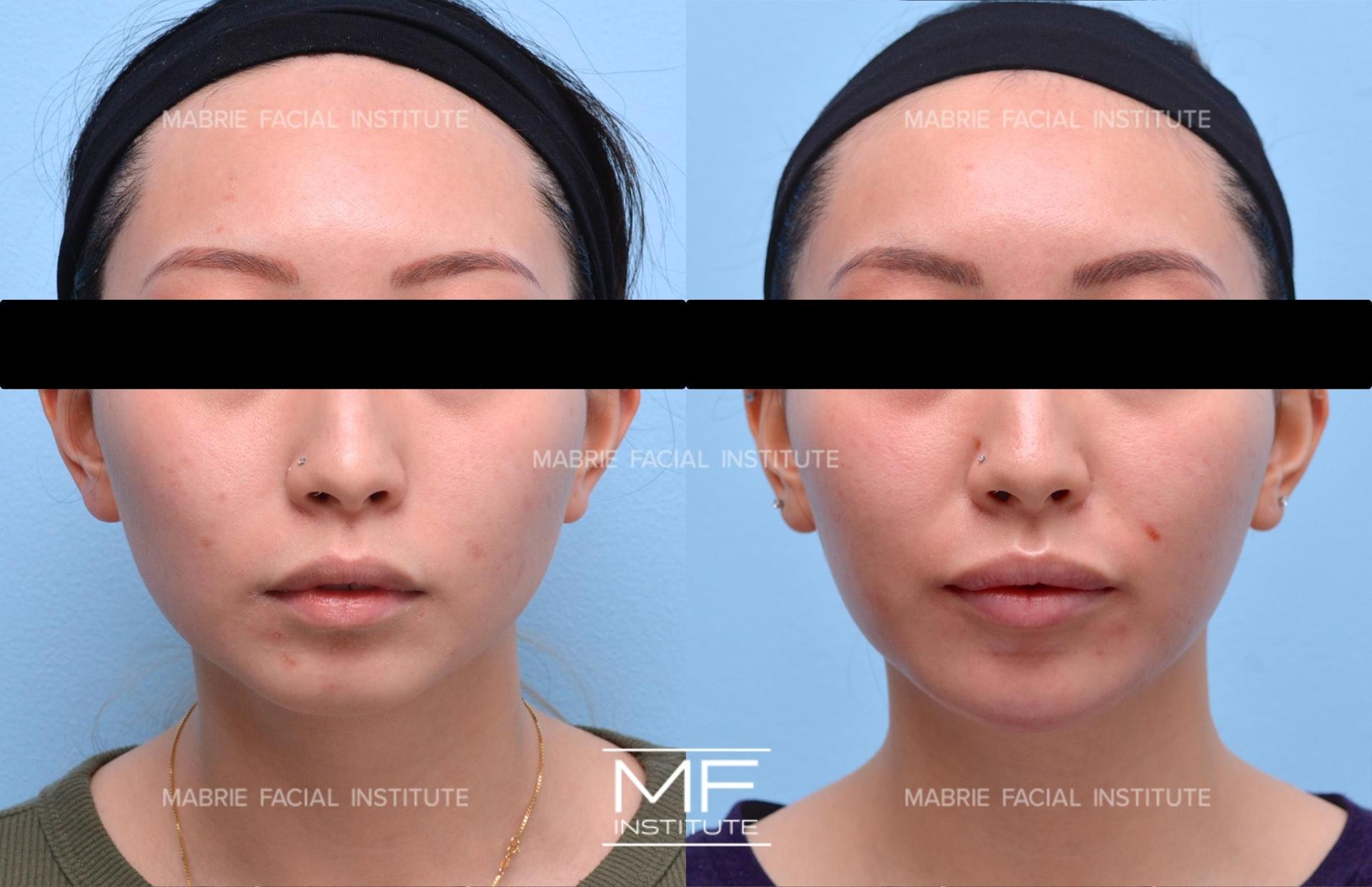 Mabrie Facial Institute chin implant result — San Francisco, CA