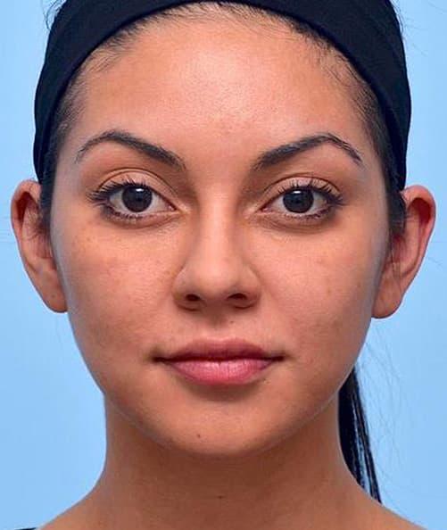 Mabrie Facial Institute after — San Francisco, CA