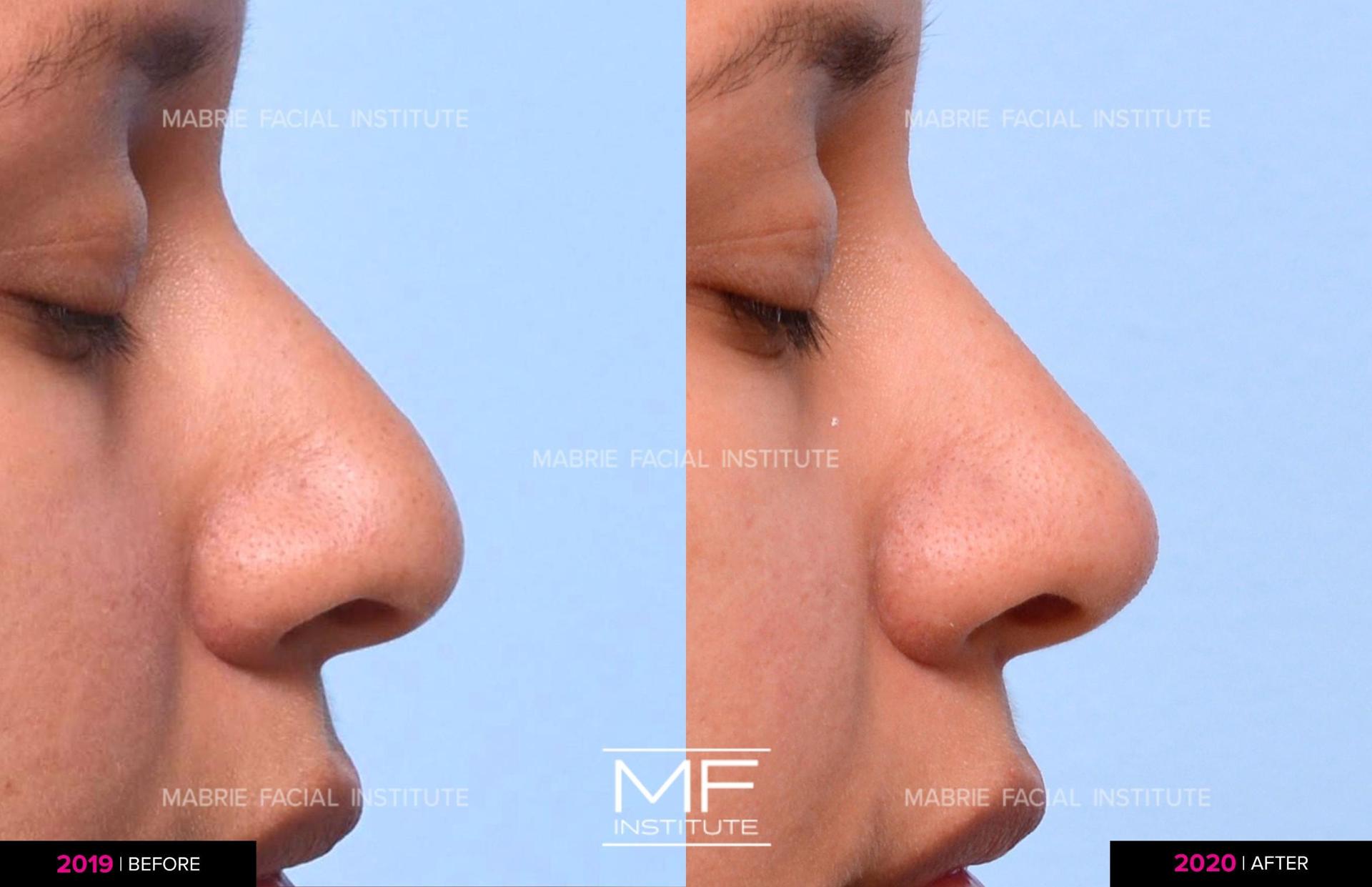 Mabrie Facial Institute rhinoplasty result — San Francisco, CA