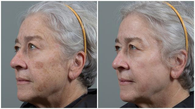 Chemical Peel result at Seiler Skin in Birmingham, AL