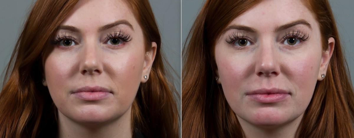 Seiler Skin laser treatment result — Birmingham, AL