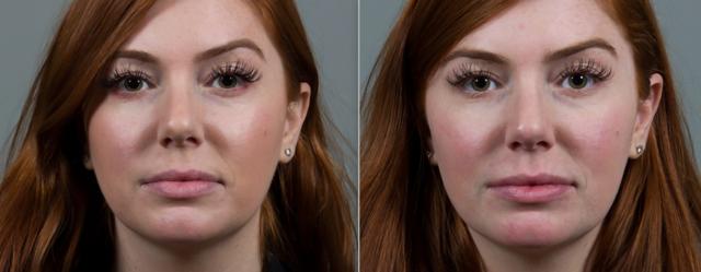 Laser Skin Resurfacing result at Seiler Skin in Birmingham, AL