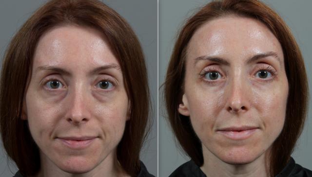 Dermal Fillers result at Seiler Skin in Birmingham, AL