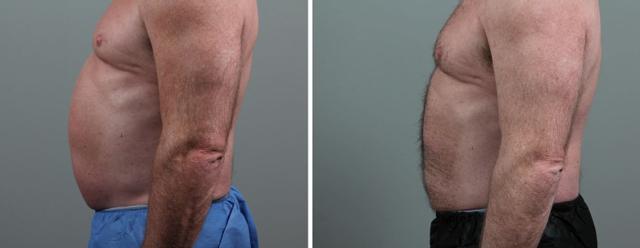 Arm Lift result at Seiler Skin in Birmingham, AL