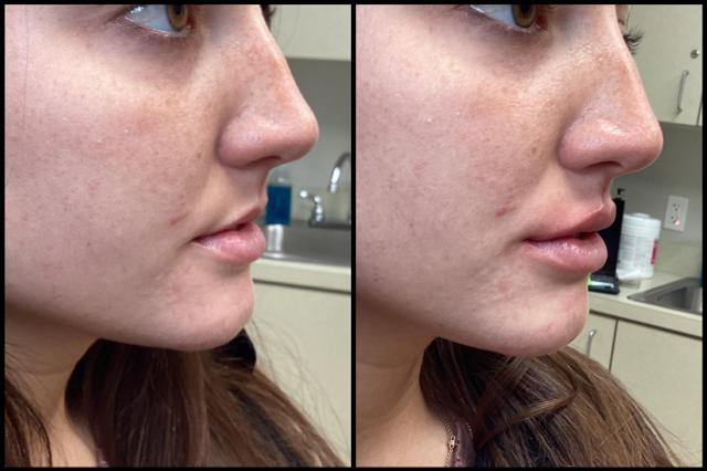 Lip Filler result at Seiler Skin in Birmingham, AL