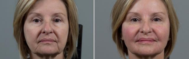 Laser Skin Resurfacing result at Seiler Skin in Birmingham, AL