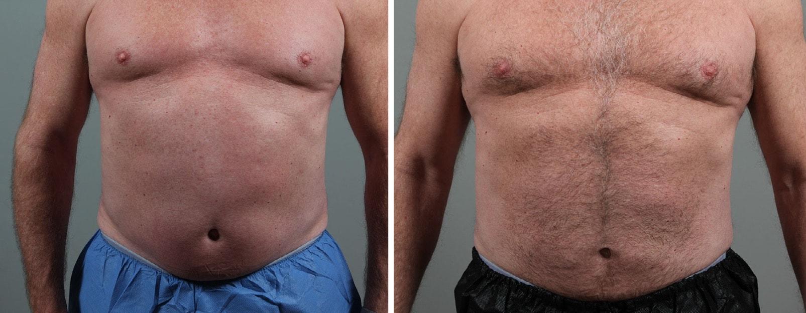 Seiler Skin body contouring result — Birmingham, AL