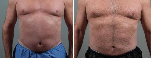 Arm Lift result at Seiler Skin in Birmingham, AL