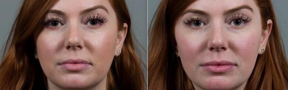 Seiler Skin laser treatment result — Birmingham, AL