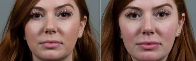 Laser Skin Resurfacing result at Seiler Skin in Birmingham, AL