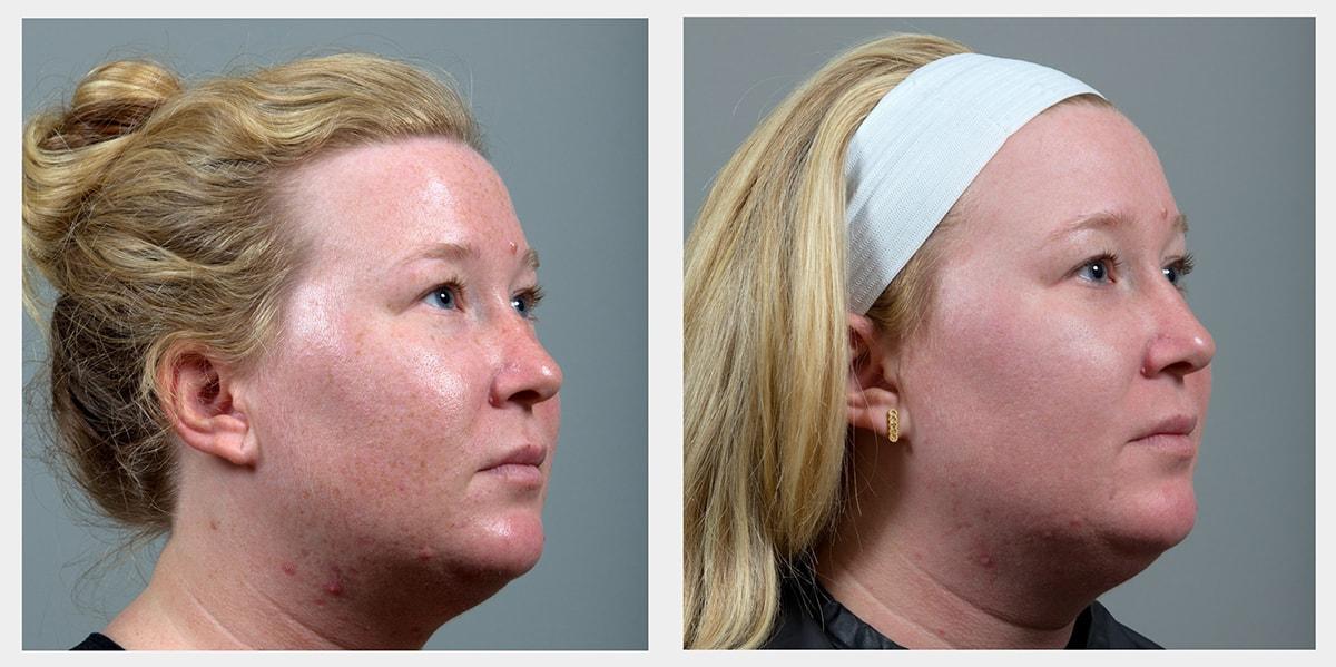 Seiler Skin laser treatment result — Birmingham, AL
