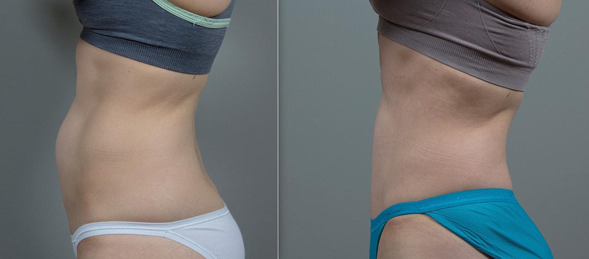 Seiler Skin body contouring result — Birmingham, AL