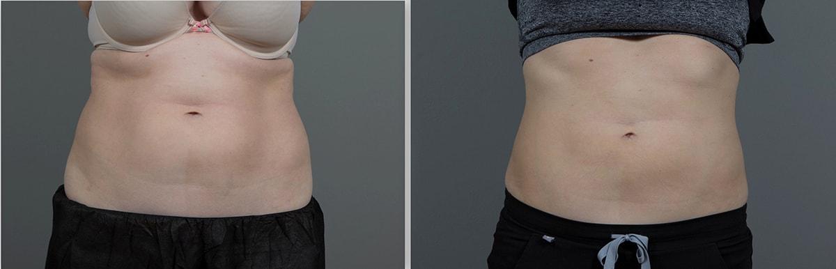 Seiler Skin body contouring result — Birmingham, AL