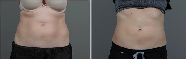 Arm Lift result at Seiler Skin in Birmingham, AL