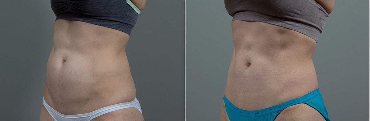 Seiler Skin body contouring result — Birmingham, AL
