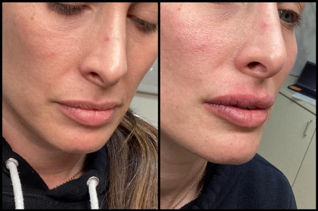 Lip Filler result at Seiler Skin in Birmingham, AL