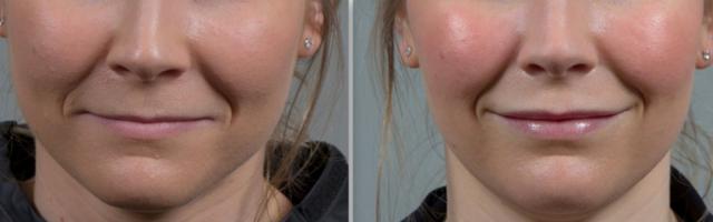 Laser Skin Resurfacing result at Seiler Skin in Birmingham, AL