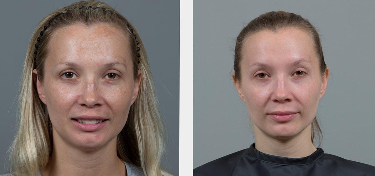 Seiler Skin laser treatment result — Birmingham, AL