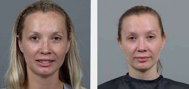 Chemical Peel result at Seiler Skin in Birmingham, AL