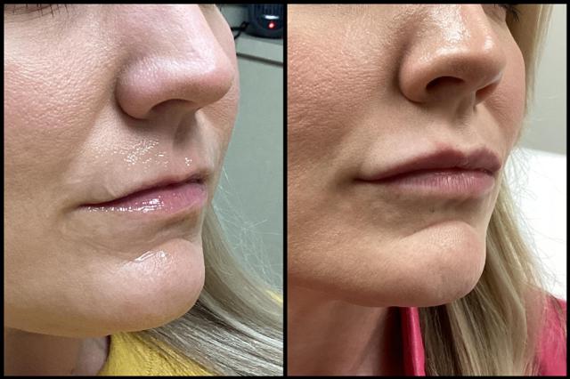 Lip Filler result at Seiler Skin in Birmingham, AL