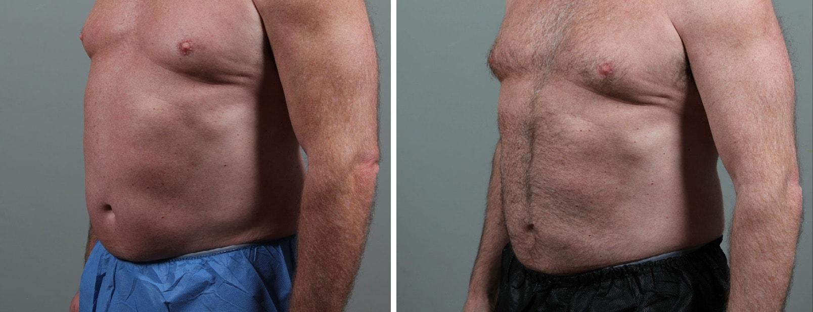 Seiler Skin body contouring result — Birmingham, AL