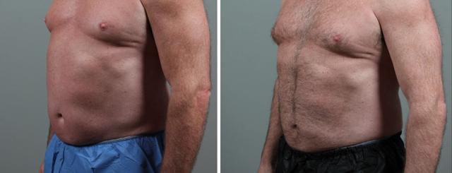 Arm Lift result at Seiler Skin in Birmingham, AL
