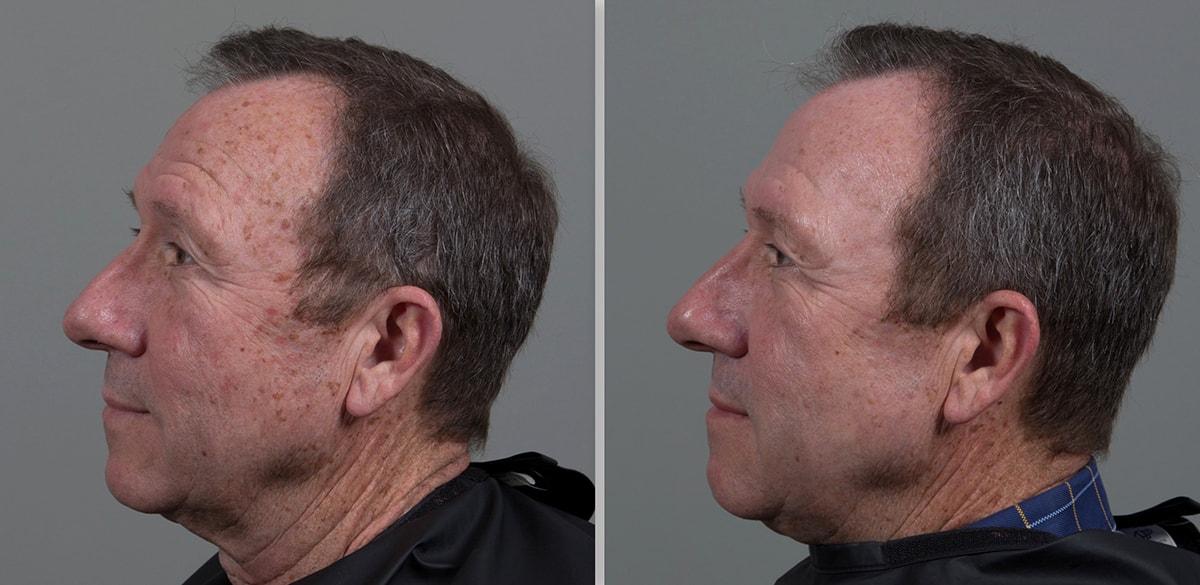 Seiler Skin laser treatment result — Birmingham, AL