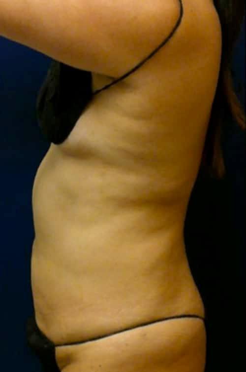 Pacific Plastic Surgery Institute - Joyce Chen MD liposuction after — Irvine, CA
