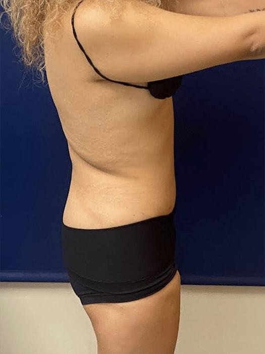 Pacific Plastic Surgery Institute - Joyce Chen MD tummy tuck after — Irvine, CA