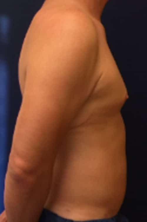 Liposuction after at Pacific Plastic Surgery Institute - Joyce Chen MD in Irvine, CA