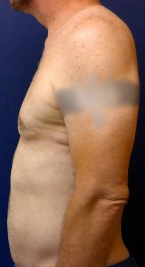 Pacific Plastic Surgery Institute - Joyce Chen MD liposuction after — Irvine, CA