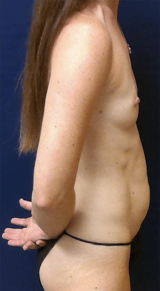 Mommy Makeover before at Pacific Plastic Surgery Institute - Joyce Chen MD in Irvine, CA