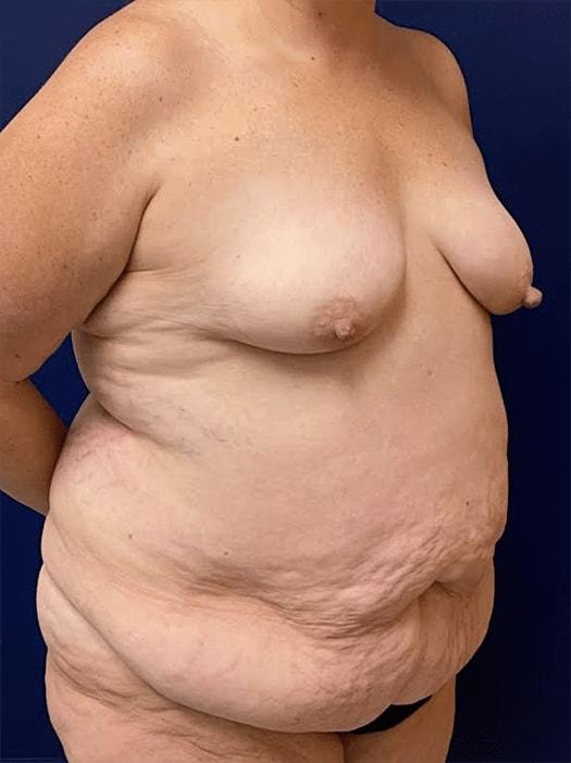 Mommy Makeover before at Pacific Plastic Surgery Institute - Joyce Chen MD in Irvine, CA