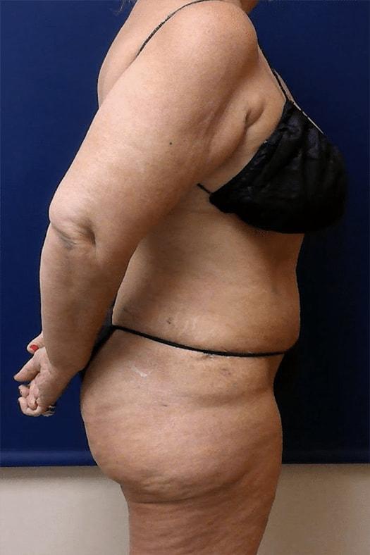 Tummy Tuck after at Pacific Plastic Surgery Institute - Joyce Chen MD in Irvine, CA