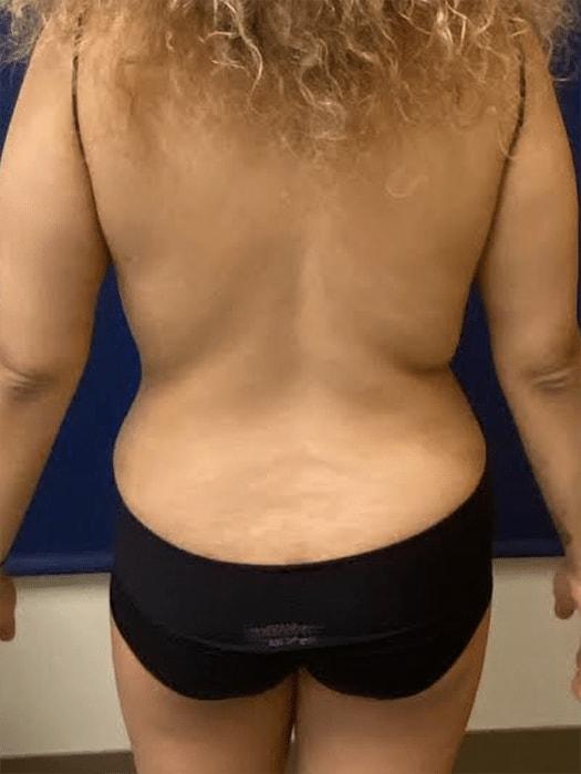 Pacific Plastic Surgery Institute - Joyce Chen MD tummy tuck after — Irvine, CA