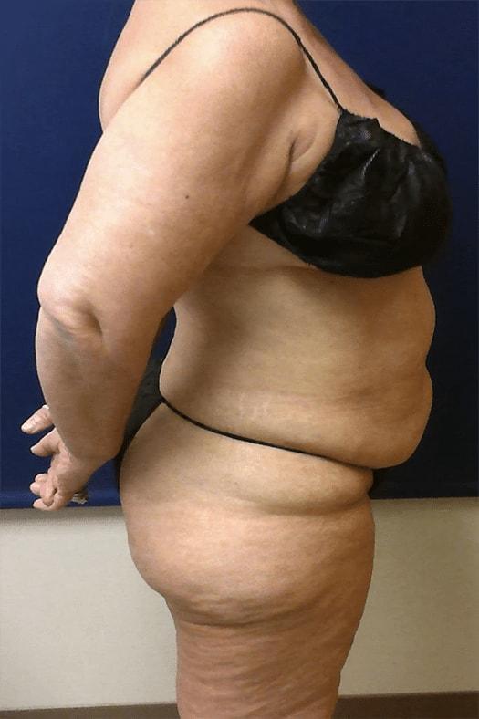 Tummy Tuck before at Pacific Plastic Surgery Institute - Joyce Chen MD in Irvine, CA