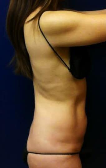 Tummy Tuck before at Pacific Plastic Surgery Institute - Joyce Chen MD in Irvine, CA
