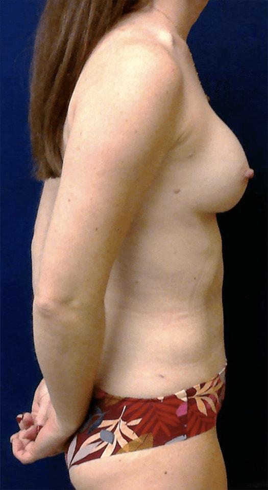 Mommy Makeover after at Pacific Plastic Surgery Institute - Joyce Chen MD in Irvine, CA