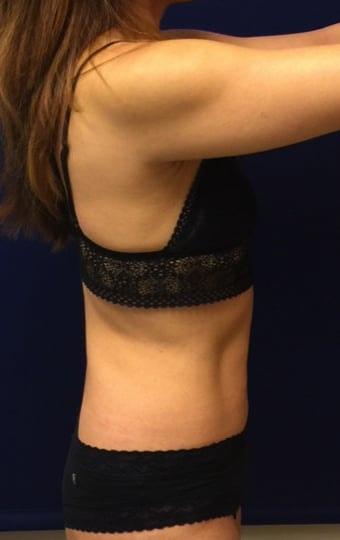 Pacific Plastic Surgery Institute - Joyce Chen MD tummy tuck after — Irvine, CA