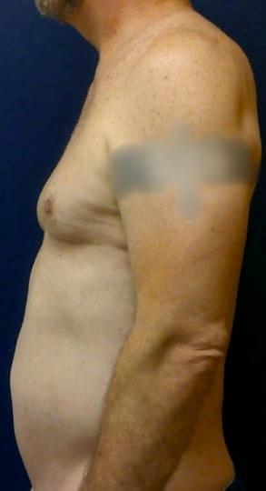 Liposuction before at Pacific Plastic Surgery Institute - Joyce Chen MD in Irvine, CA