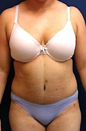 Pacific Plastic Surgery Institute - Joyce Chen MD tummy tuck after — Irvine, CA