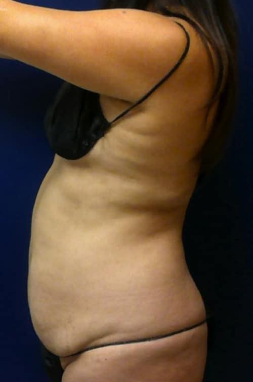 Liposuction before at Pacific Plastic Surgery Institute - Joyce Chen MD in Irvine, CA